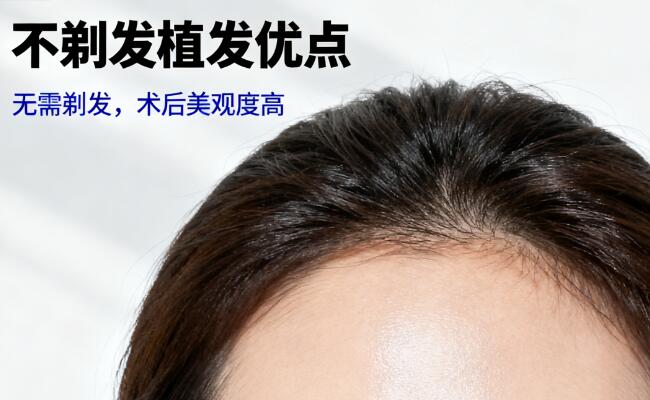 不剃发植发:打破尴尬,重塑自然发际线的“隐形革命”