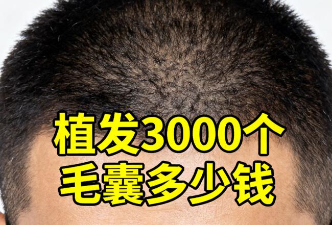 3000毛囊植发价格大揭秘：从2万到10万的“天壤之别”