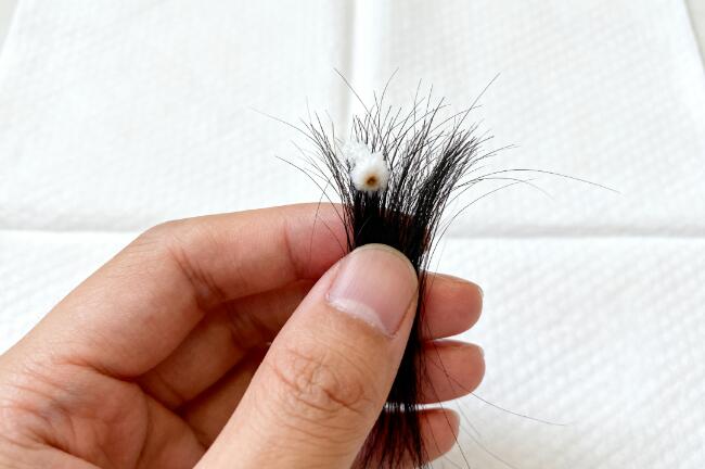 植发后狂脱期是怎么回事?正常现象还是手术失败?科学应对指南来了!