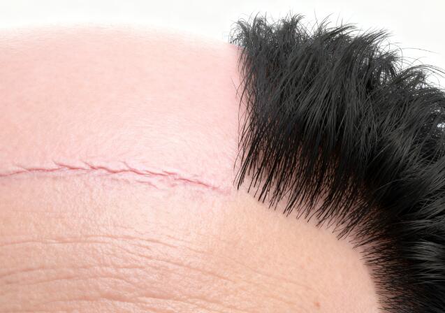 3D毛囊活化技术：疤痕脱发修复的革命性突破