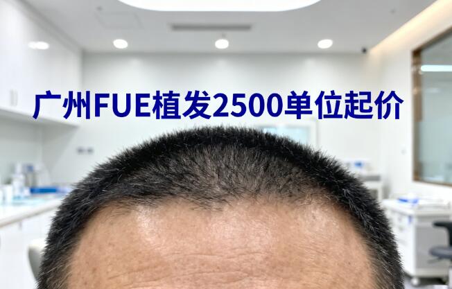 广州FUE植发2500单位起价解析：技术、机构与性价比全攻略