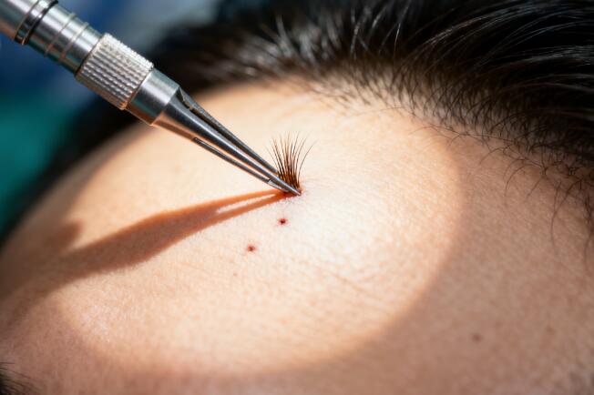 美人尖种植单根毛囊技术溢价：为何价格差异高达3倍？