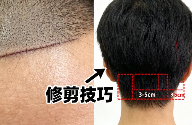 短发爱好者FUT疤痕隐藏技巧：告别“秃头焦虑”，自信露额不是梦！