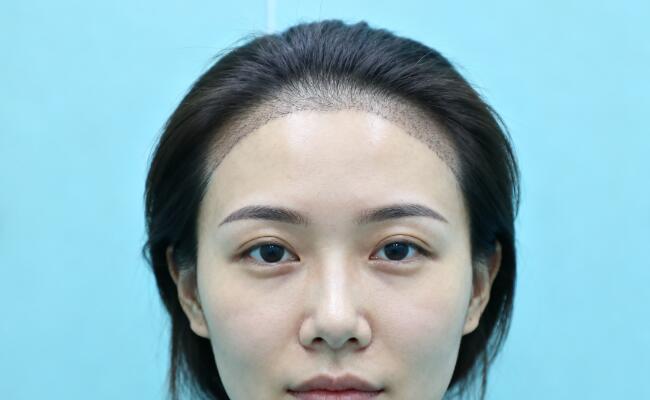 发际线生硬二次重塑方案：告别“假发感”，重塑自然美