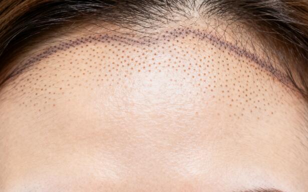 头皮微色素着色：弥补密度不足的“视觉魔法”