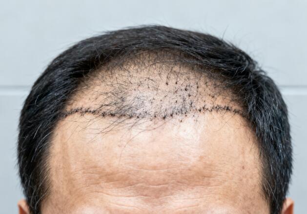 长期熬夜，正在“偷走”你的植发效果！