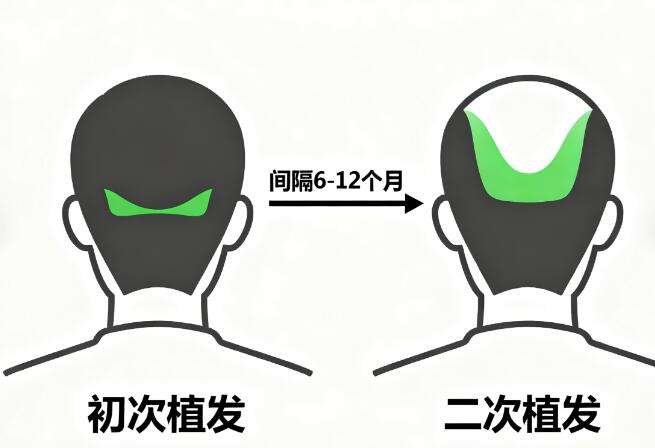 二次植发与初次间隔多久？科学答案：至少12个月！