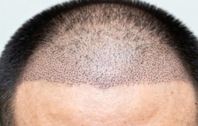 超精细不剃发植发单次提取量:为何2000单位是黄金上限?