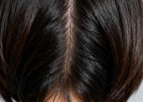 短发控必看!FUT植发疤痕隐藏全攻略,让你自信露后脑勺