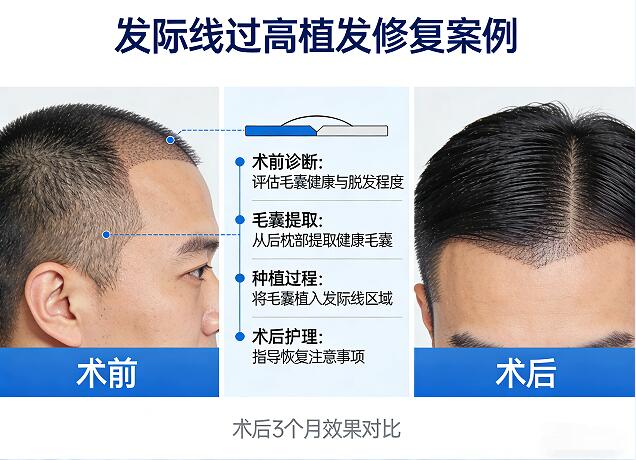 植发后头发干枯毛躁？养护秘籍让你重获柔顺秀发！