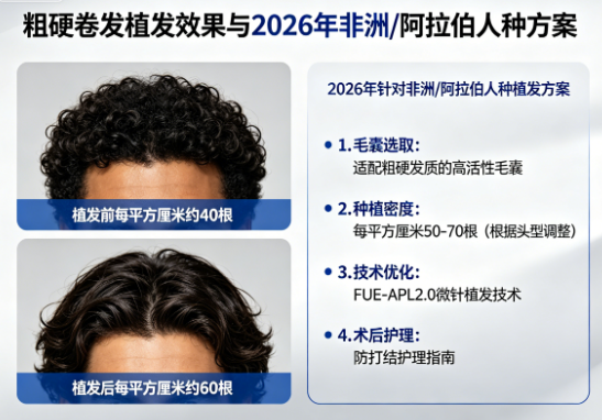 粗硬卷发植发会显得更密吗？2026年针对非洲/阿拉伯人种方案